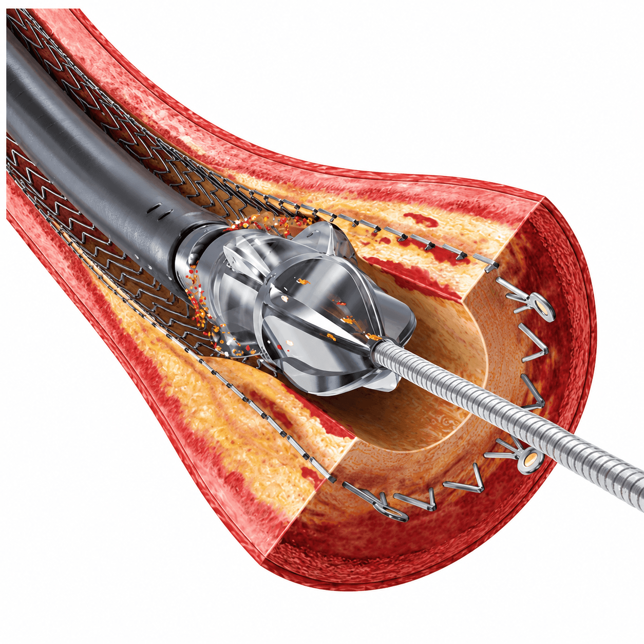 Image of Peripheral atherectomy device