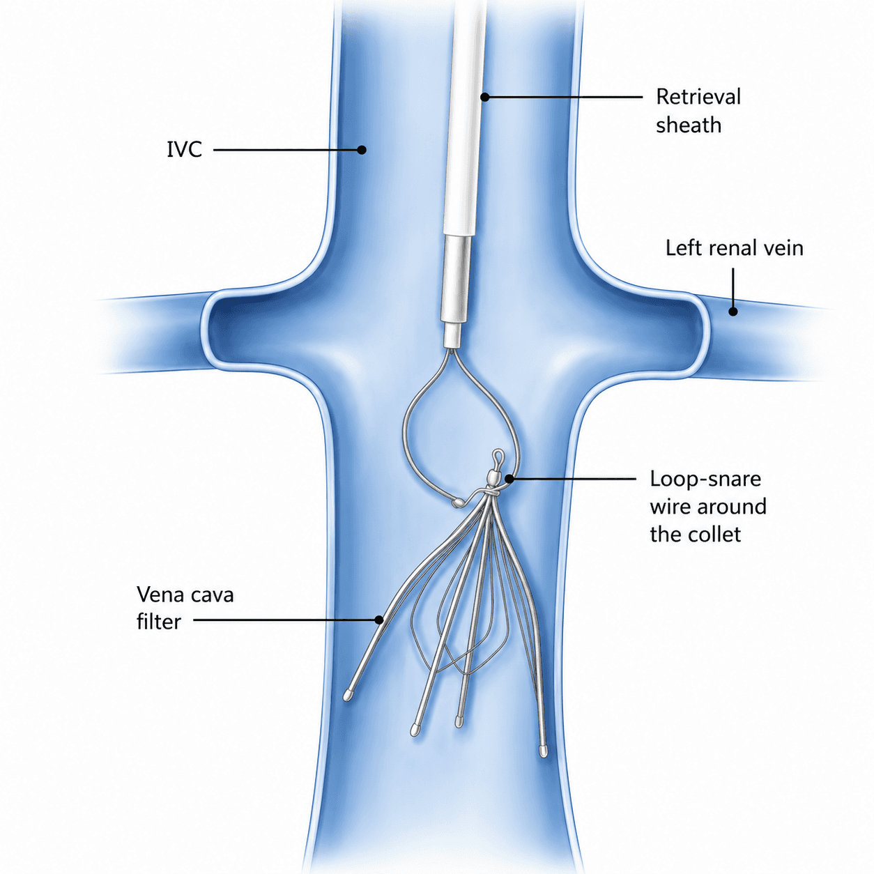 Image of IVC filter retrieval sheath