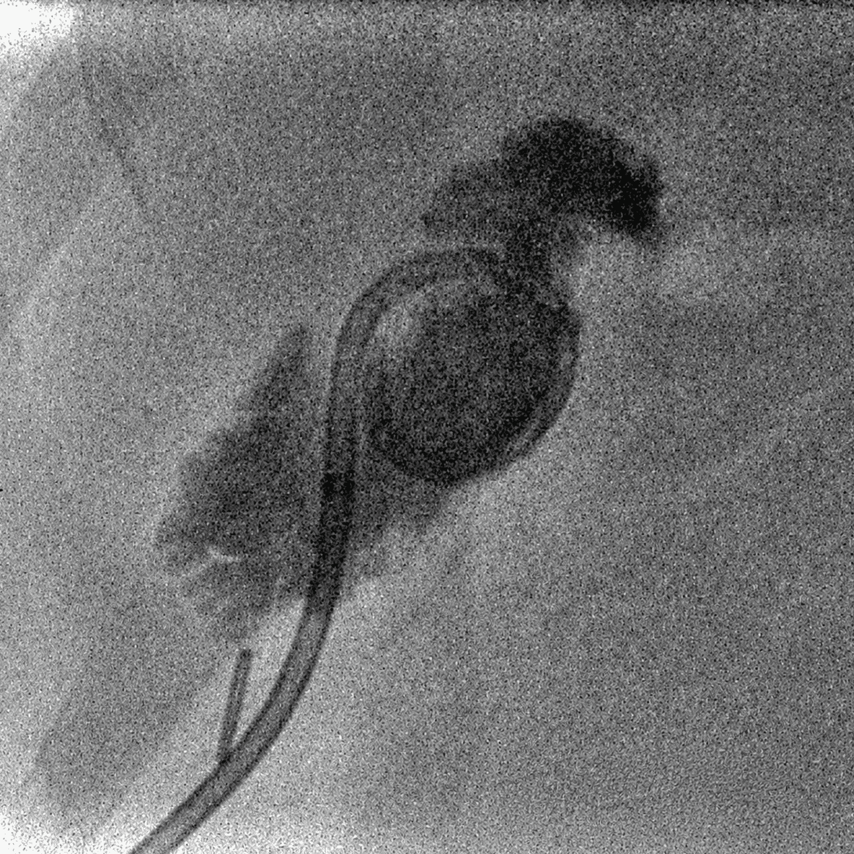 Image of Percutaneous cholecystostomy catheter