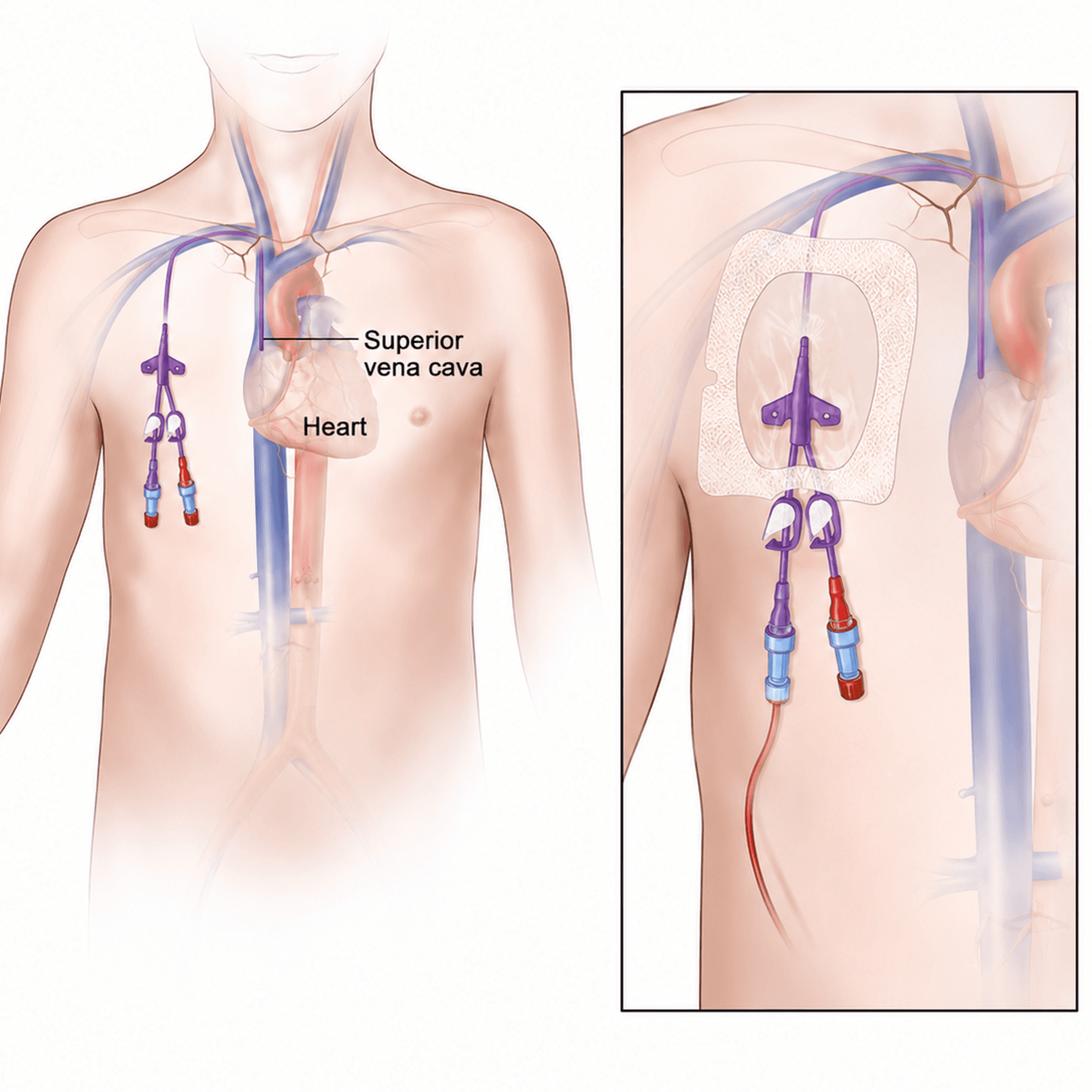 Image of Tunneled small-bore central venous catheter