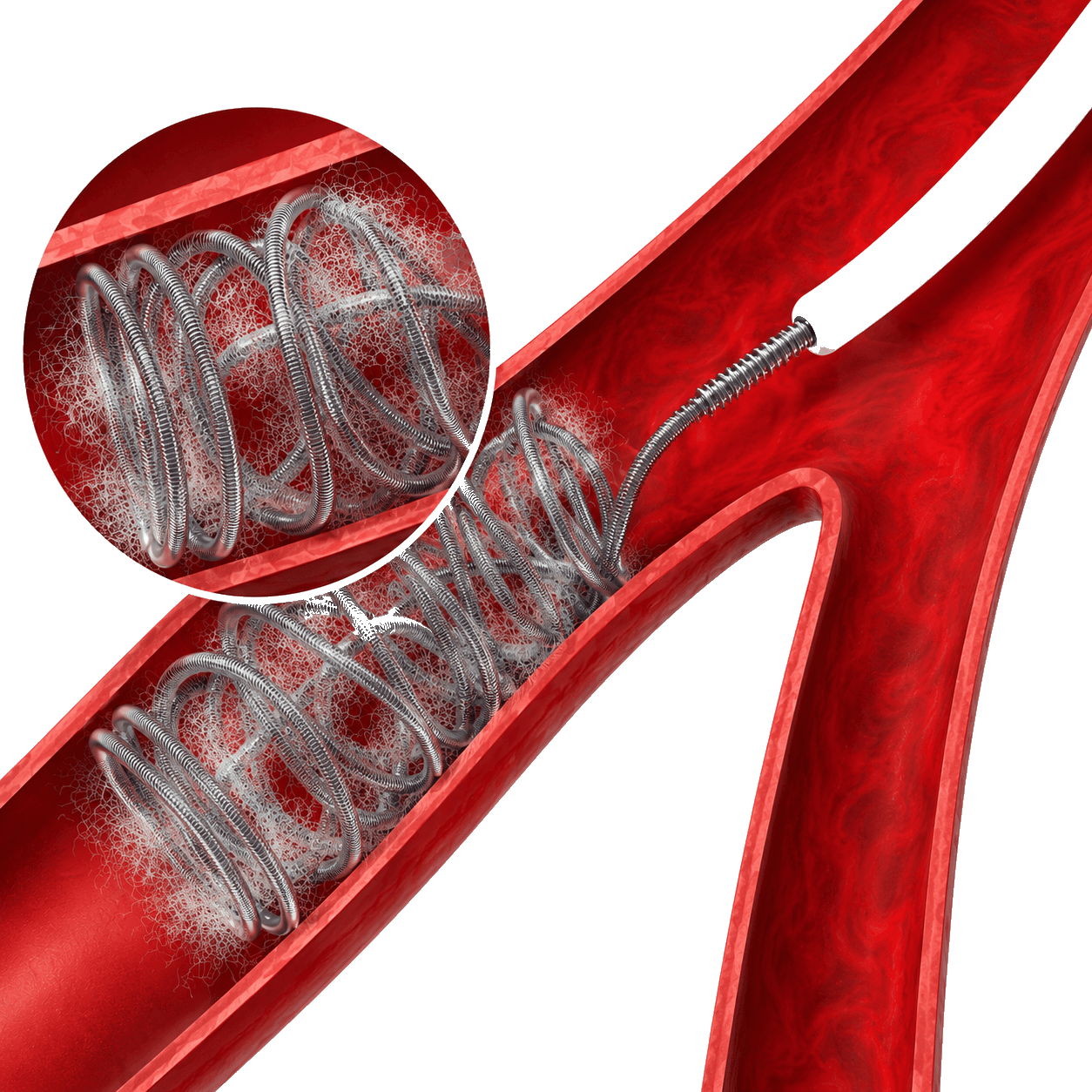 Image of Embolization coils (pushable and detachable)