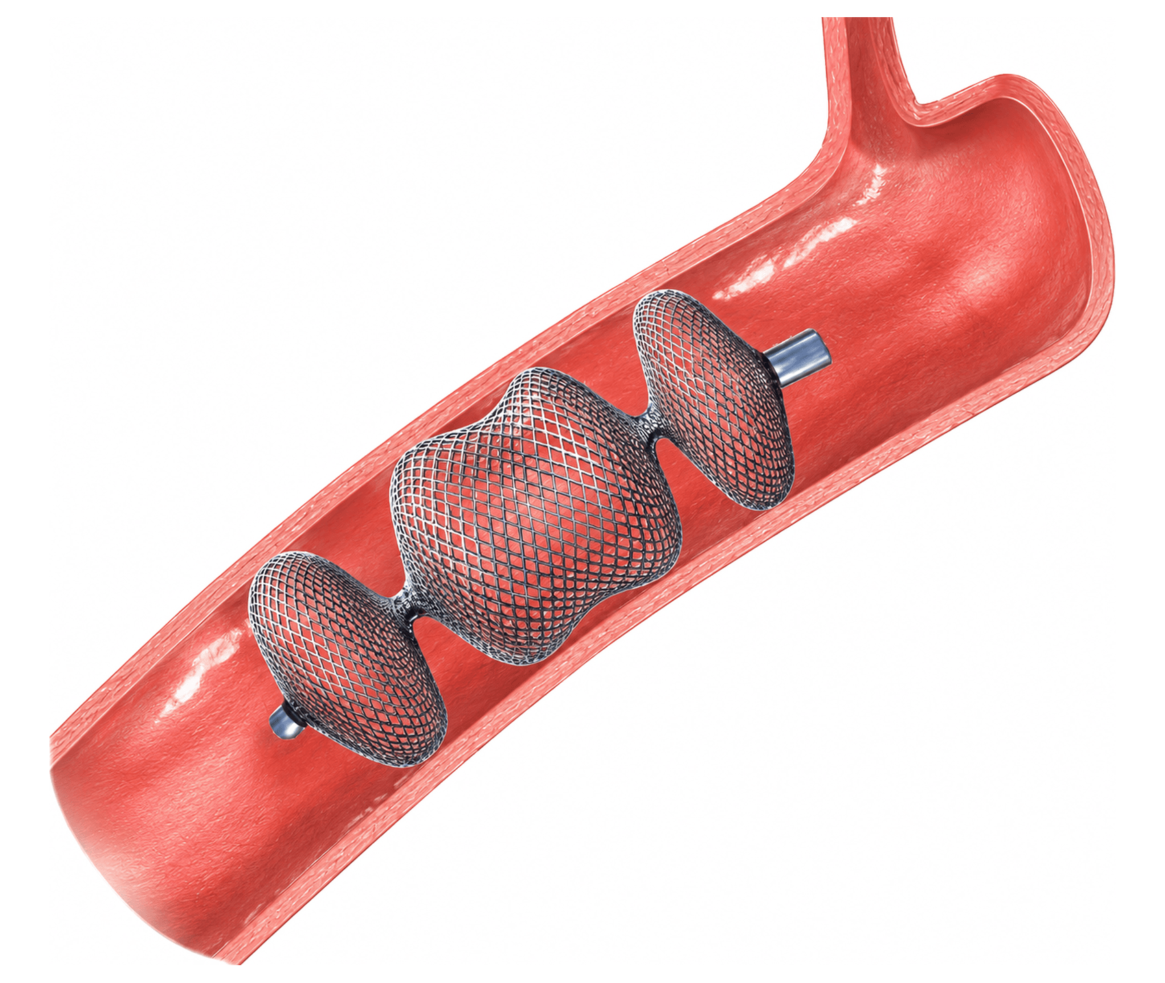 Image of Vascular plug