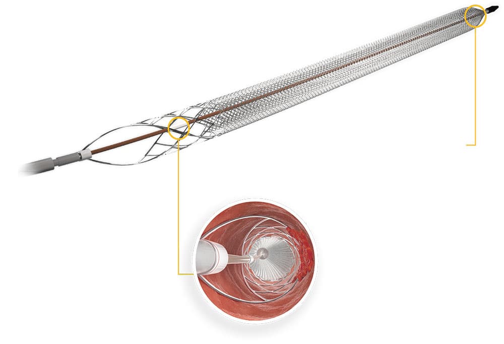 Image of ClotTriever® thrombectomy system