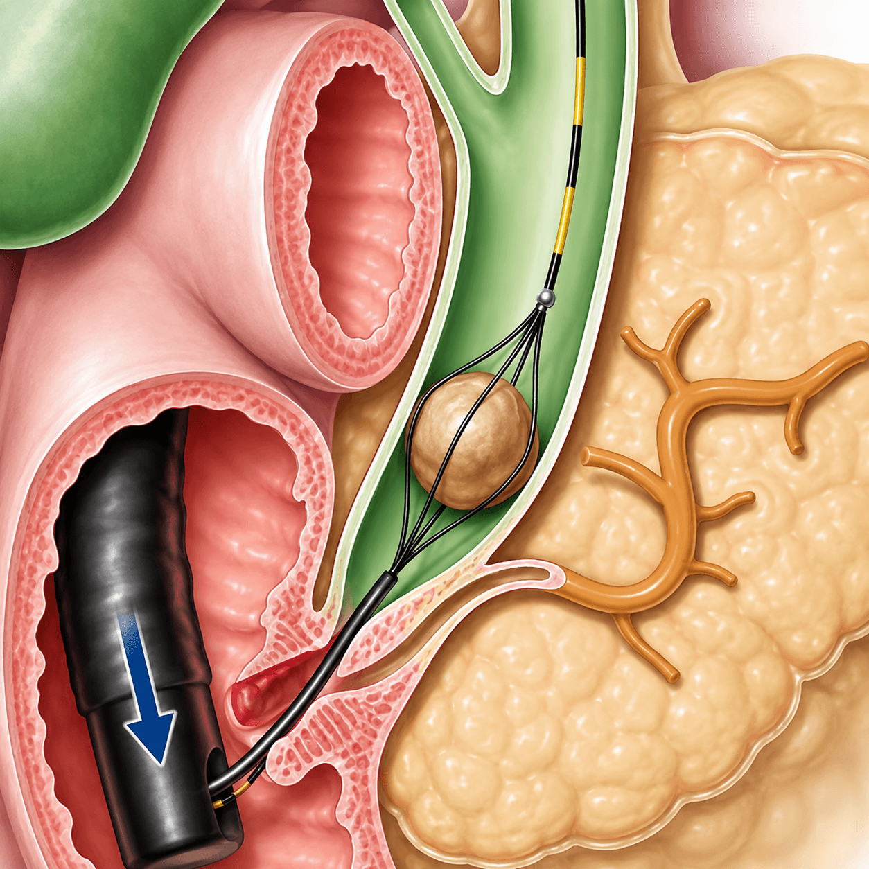 Image of Biliary stone retrieval basket