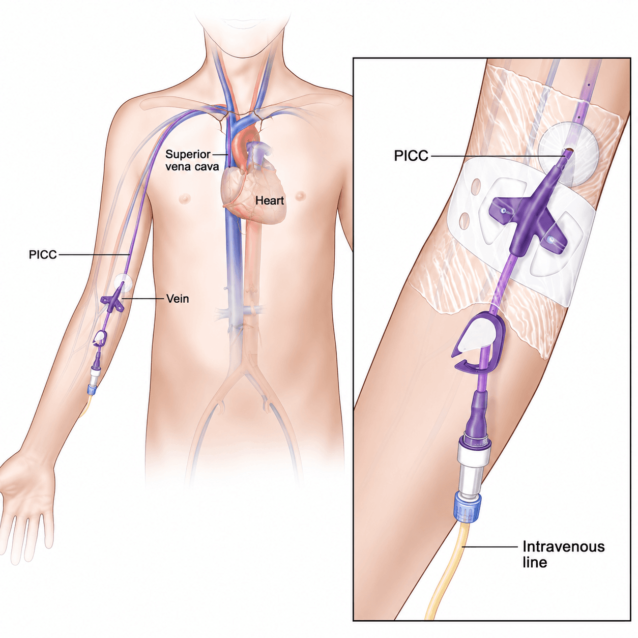 Image of Peripherally inserted central catheter (PICC)