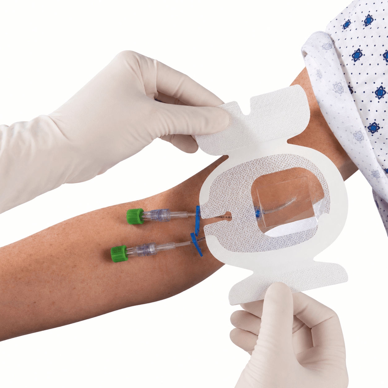 Image of Chlorhexidine-impregnated dressing